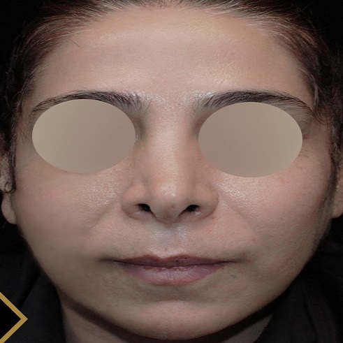 after-face-lift-dr-arash-najaf-beygi
